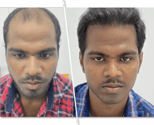 Hair Transplantation_1